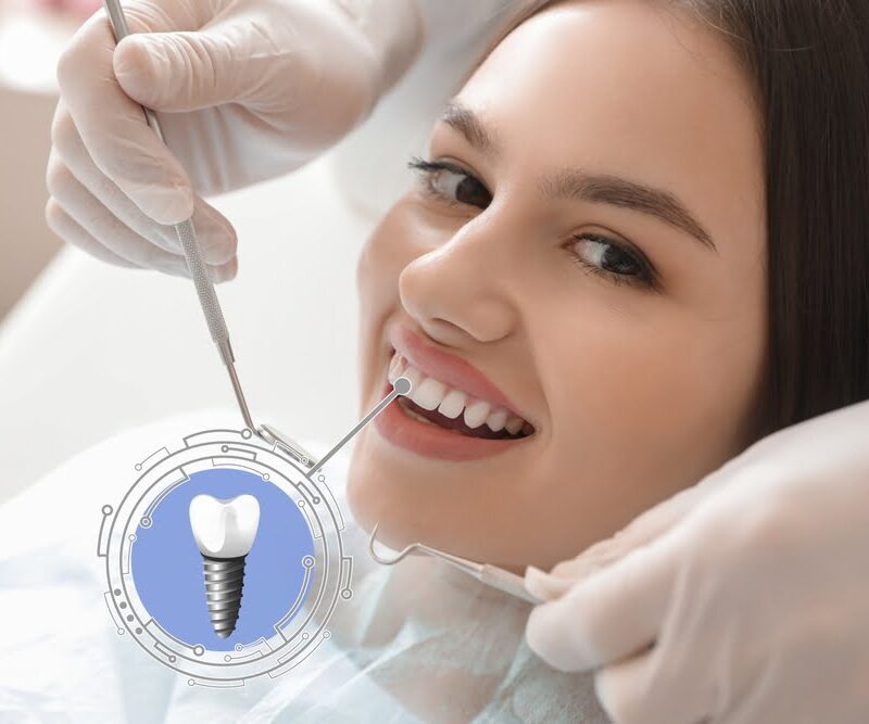 Dental Implants vs. Veneers