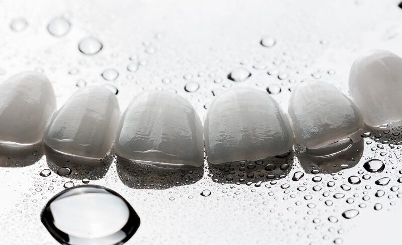 What Is Dental Veneer And How Is It Done?