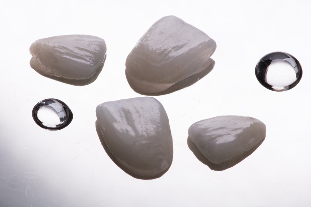 Emax vs Other Veneers