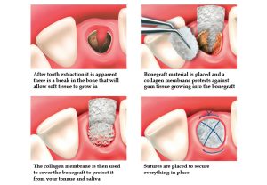 Clinical photo sequence of dental bone graft placement following tooth extraction, showing grafting material and healing process