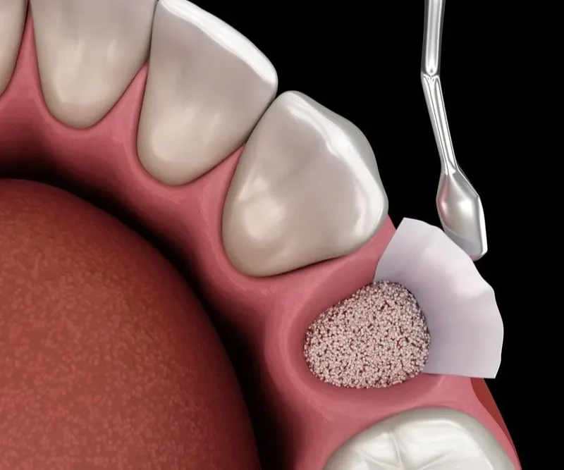 Dental bone graft procedure showing step-by-step socket preservation after tooth extraction
