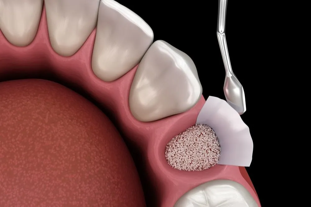 Is a Bone Graft Necessary After a Tooth Extraction?