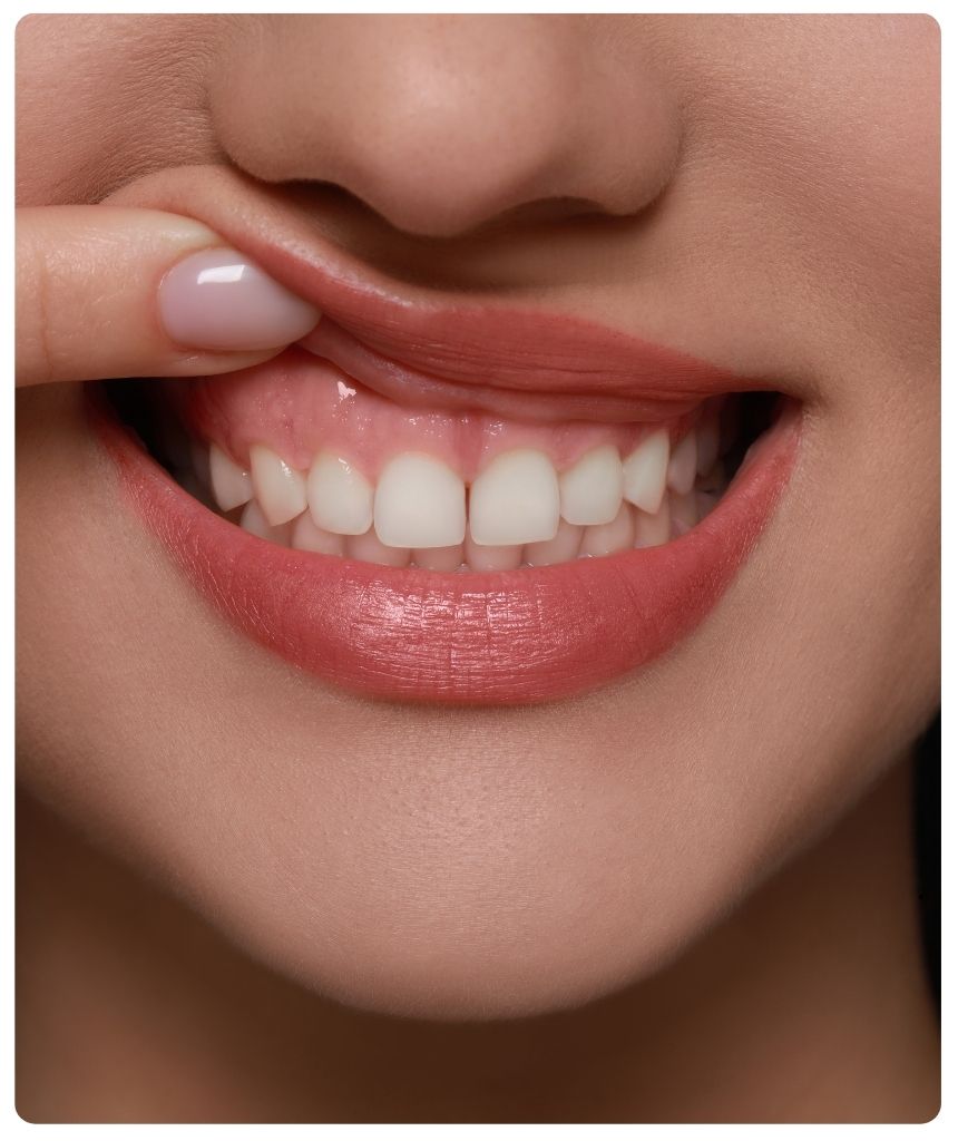 Diş Eti Beyazlatma Hizmeti