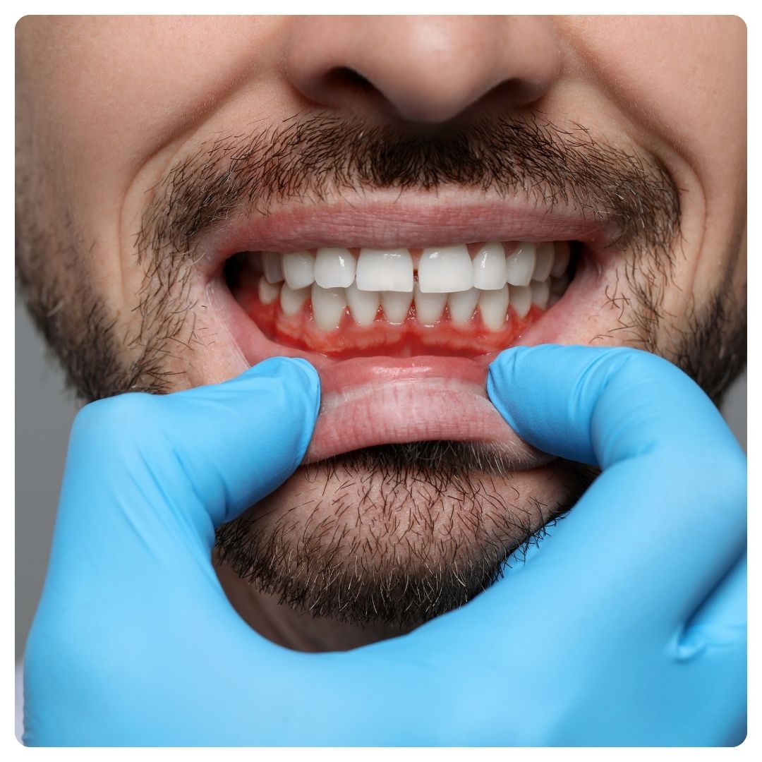 Gum Contouring in Istanbul