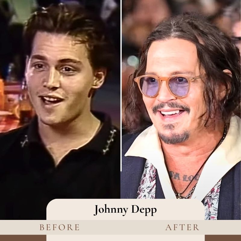 Johnny Depp Teeth veneers before and after