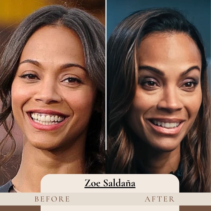 Zoe Saldana Teeth Before and After