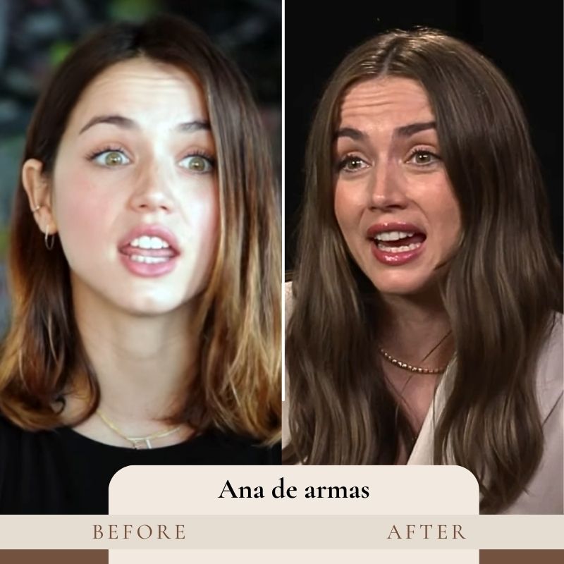 Ana de Armas Teeth Before and After
