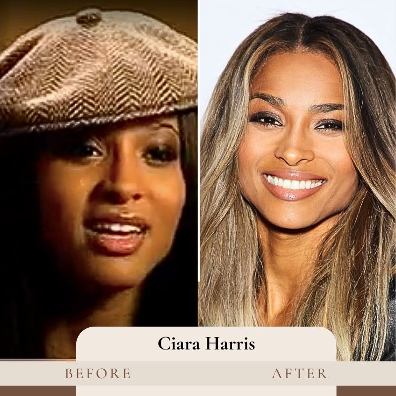 Ciara Harris Teeth Before and After