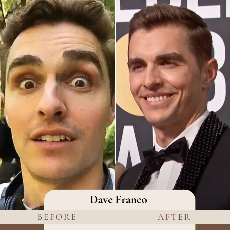 Dave Franco Teeth Before and After