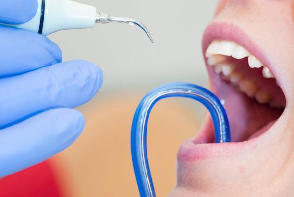 diş taşı temizliği