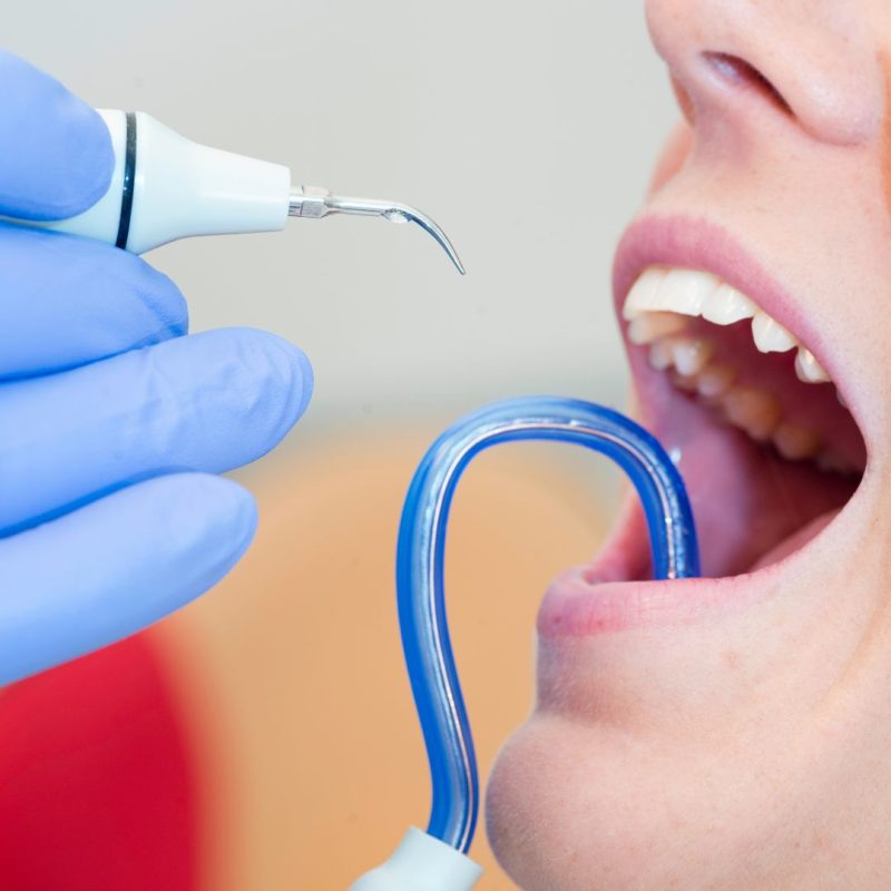 diş taşı temizliği