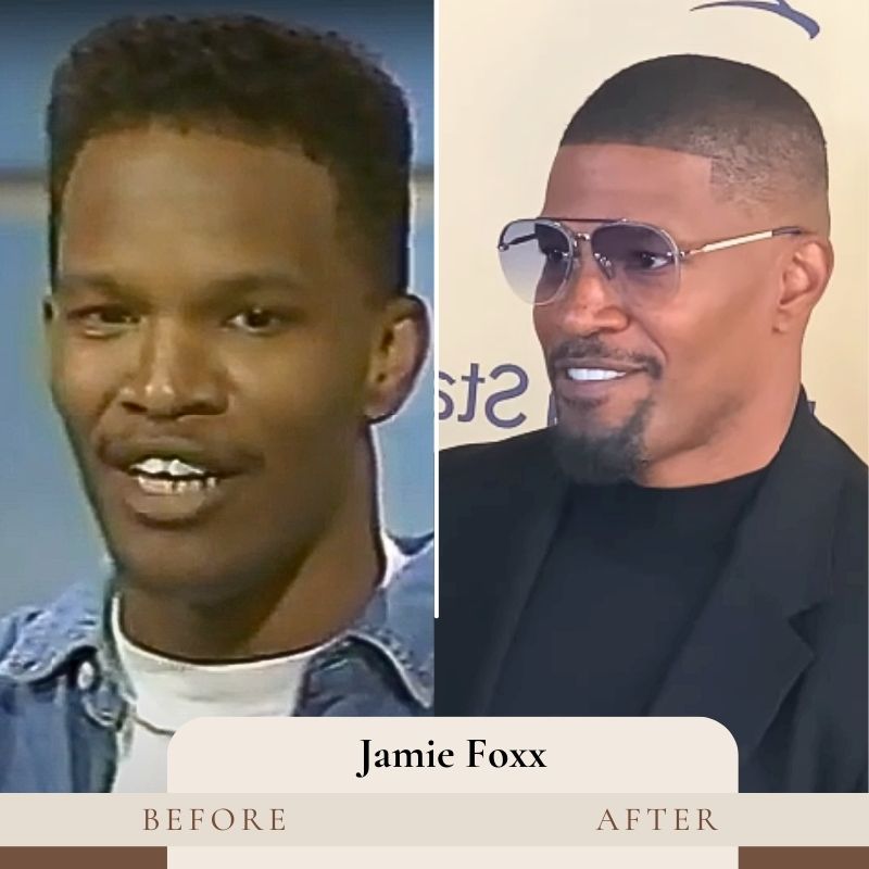 Jamie Foxx Teeth Before and After