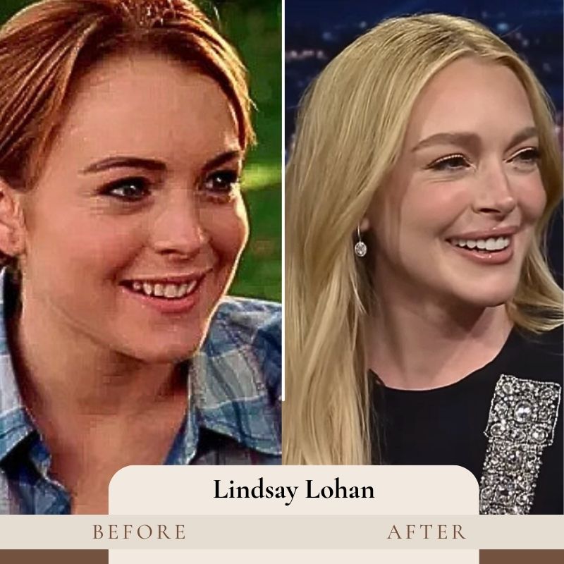 Lindsay Lohan Teeth Before and After