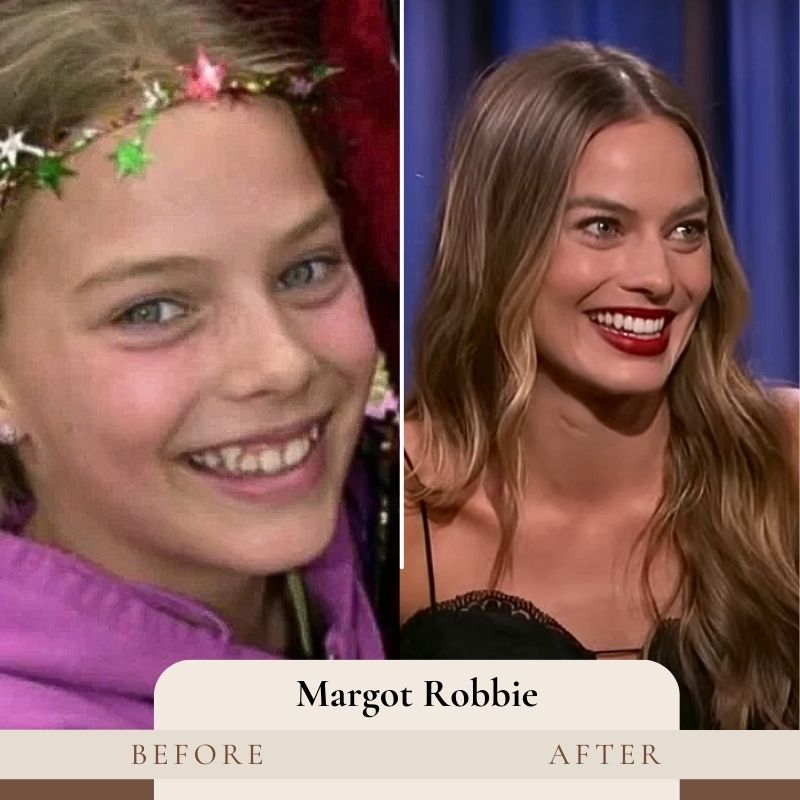 Margot Robbie Teeth Before and After