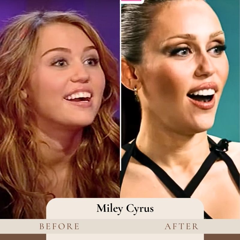 Miley Cyrus Teeth Before and After