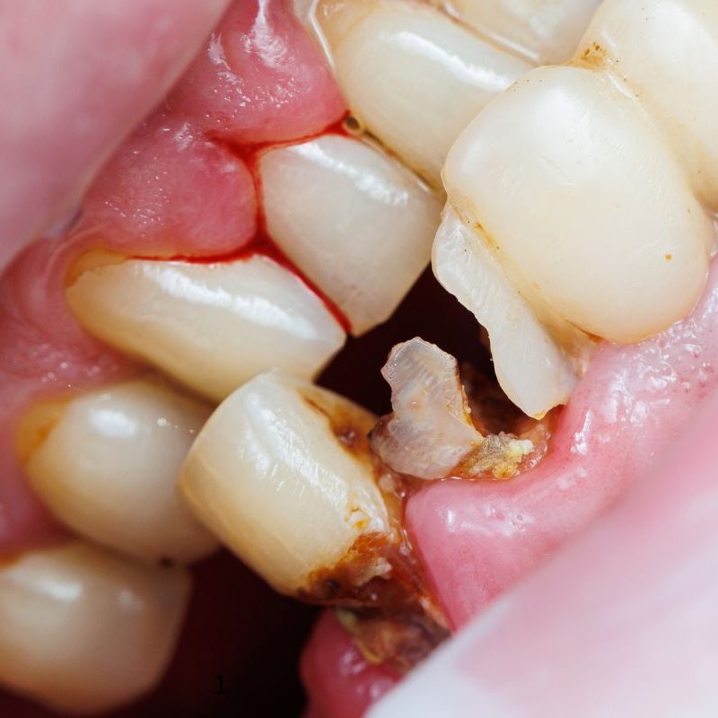 Rotten teeth solution guide