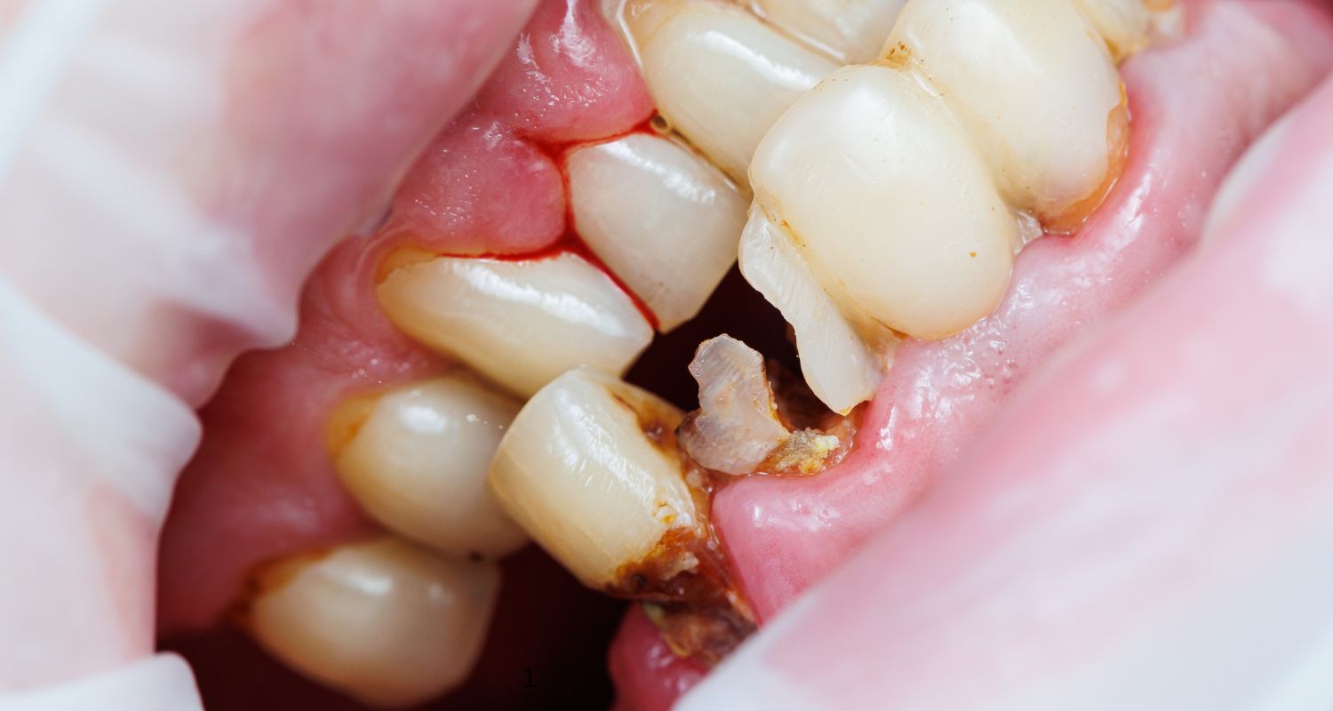 Rotten Teeth Solutions: Your Complete Guide to Fixing Bad Teeth