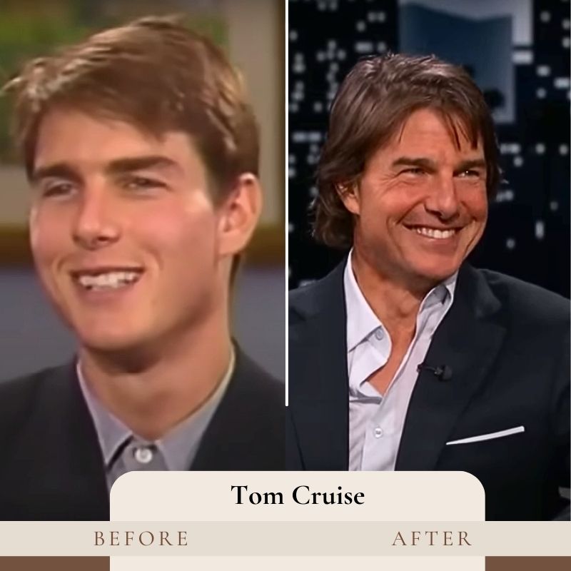 Tom Cruise teeth veneers before and after