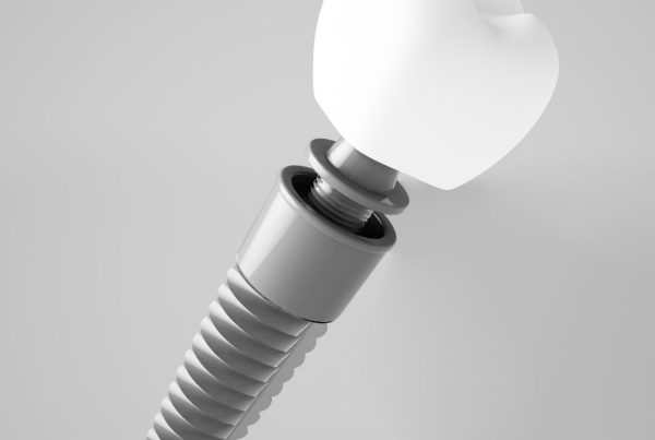 top 10 dental implant brands