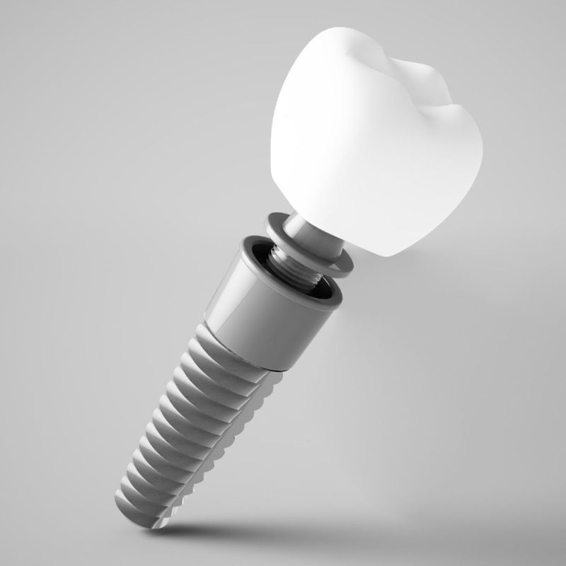 top 10 dental implant brands