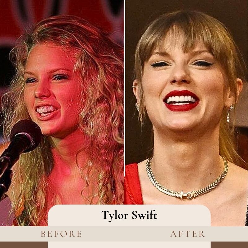 Taylor Swift Teeth Before and After