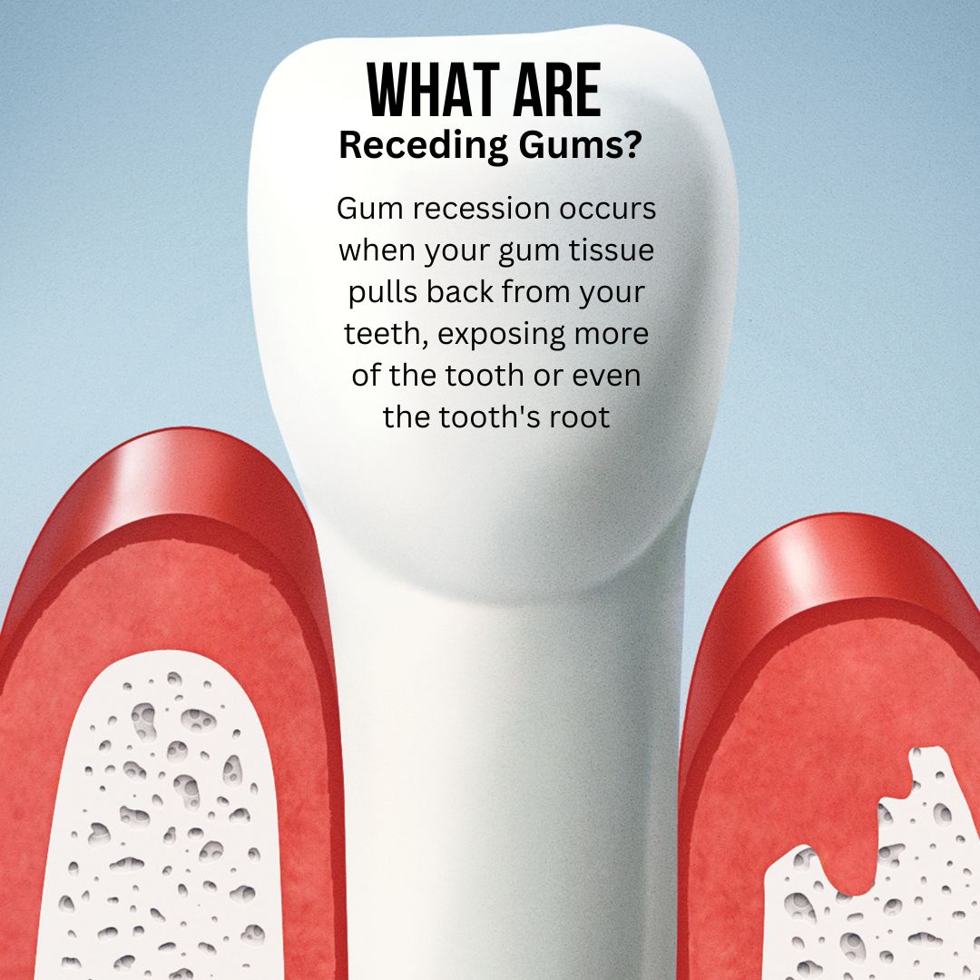 What are receding gums