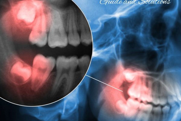 wisdom teeth guide solutions