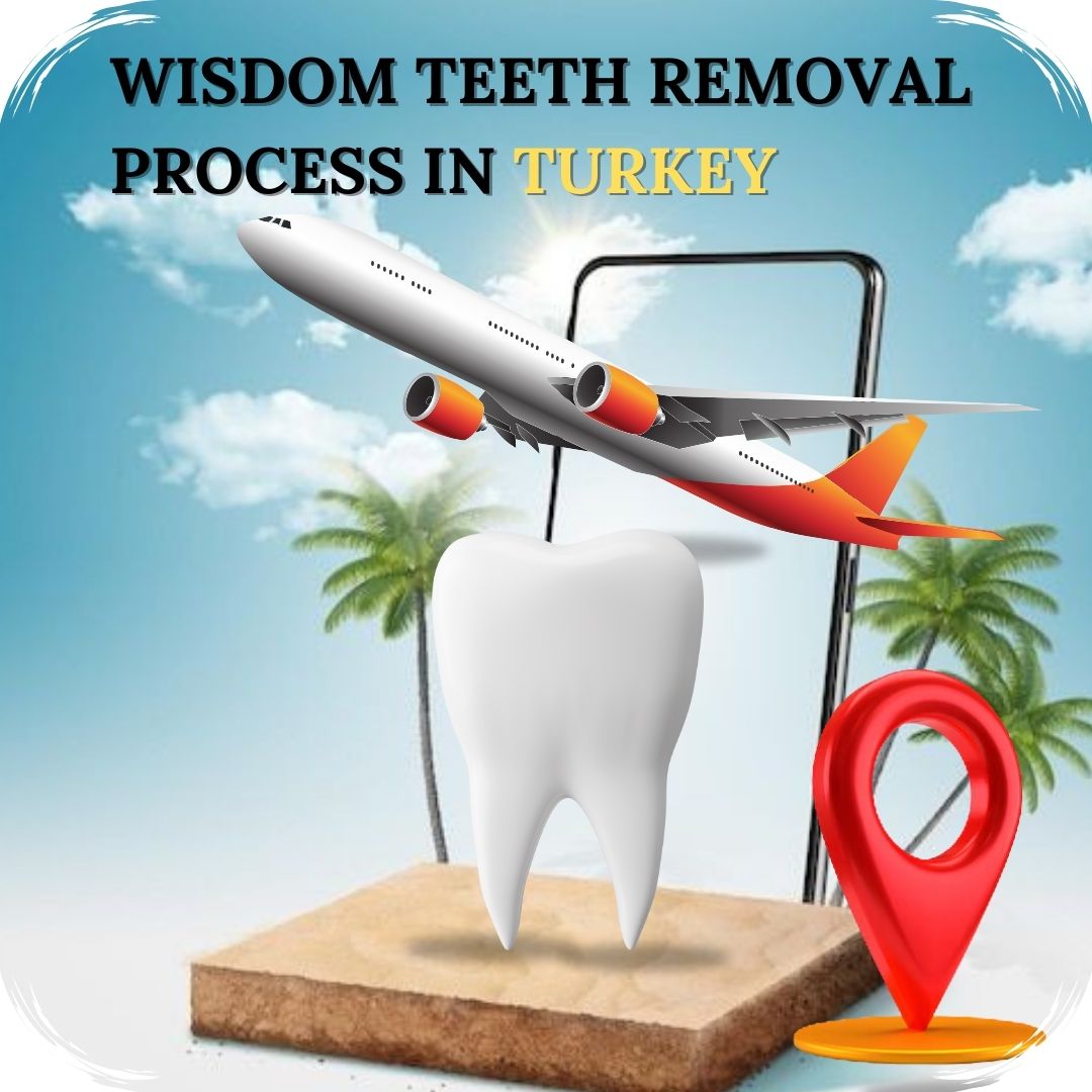 Wisdom teeth removal