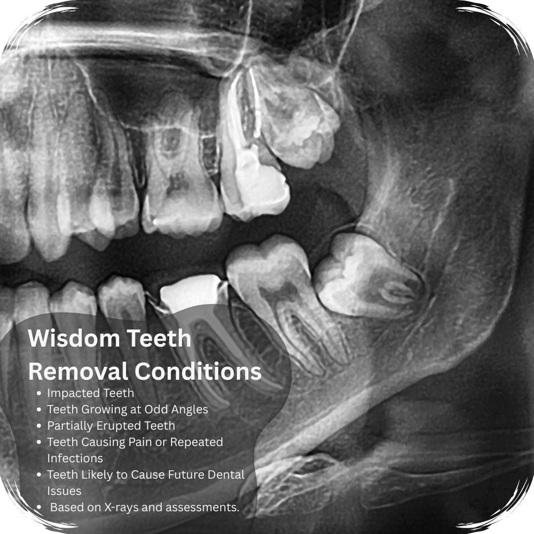 Wisdom teeth removal conditions