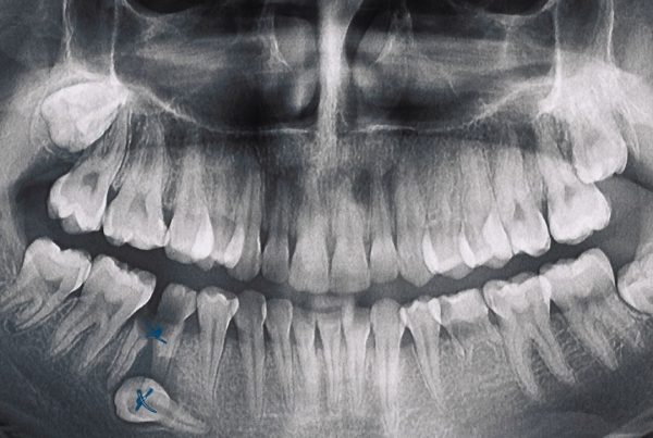 Dental Bone Loss Causes and Treatments