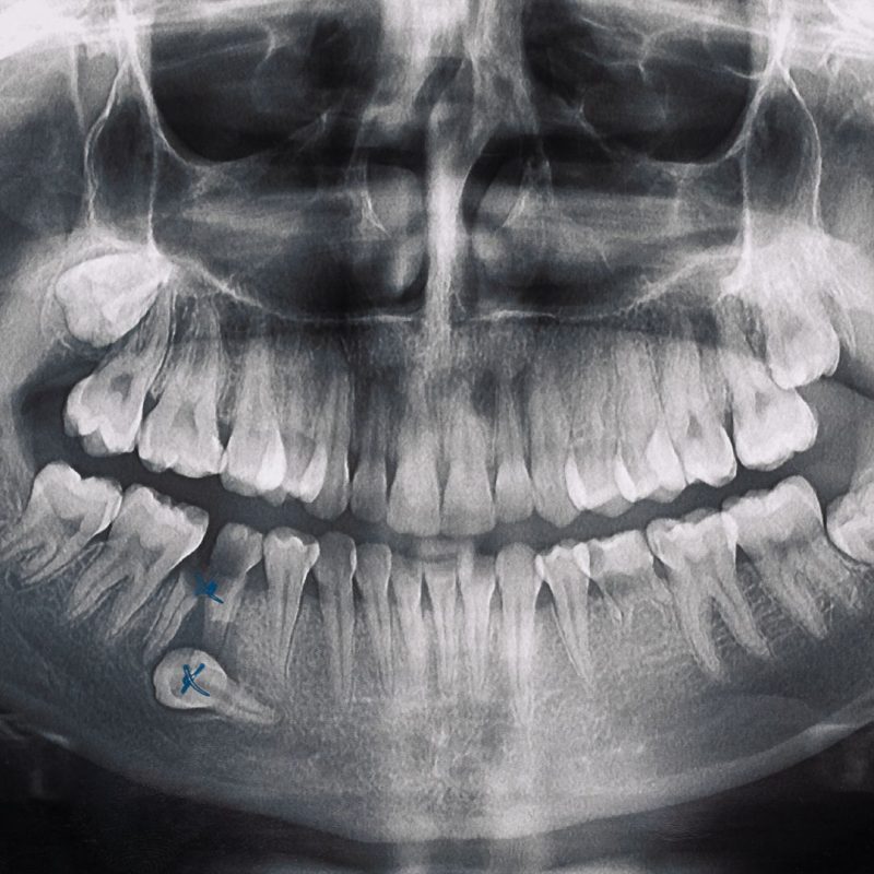 Dental Bone Loss Causes and Treatments