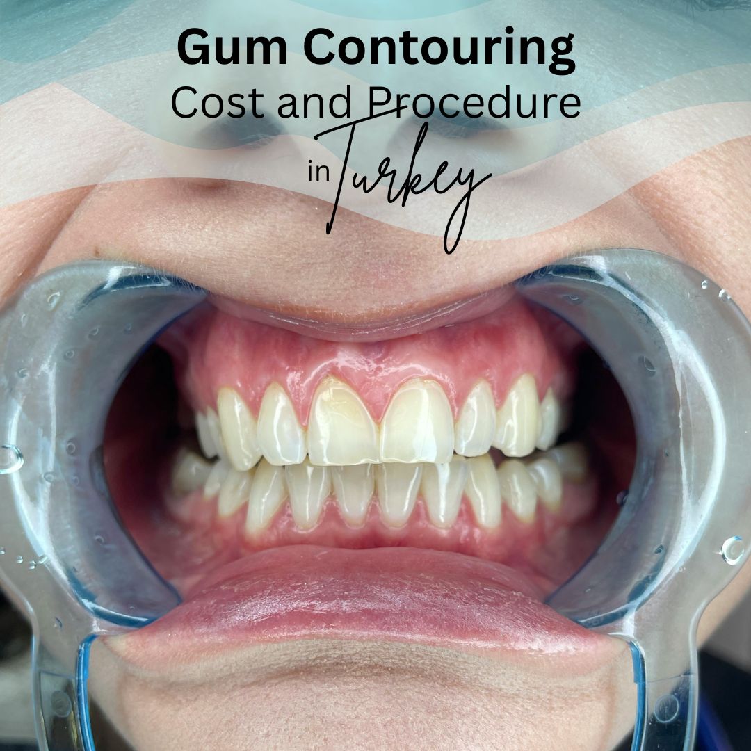 Gum Contouring cost and procedure in Istanbul Turkey