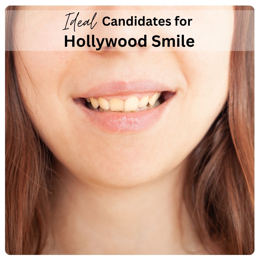 Candidates for Hollywood Smile