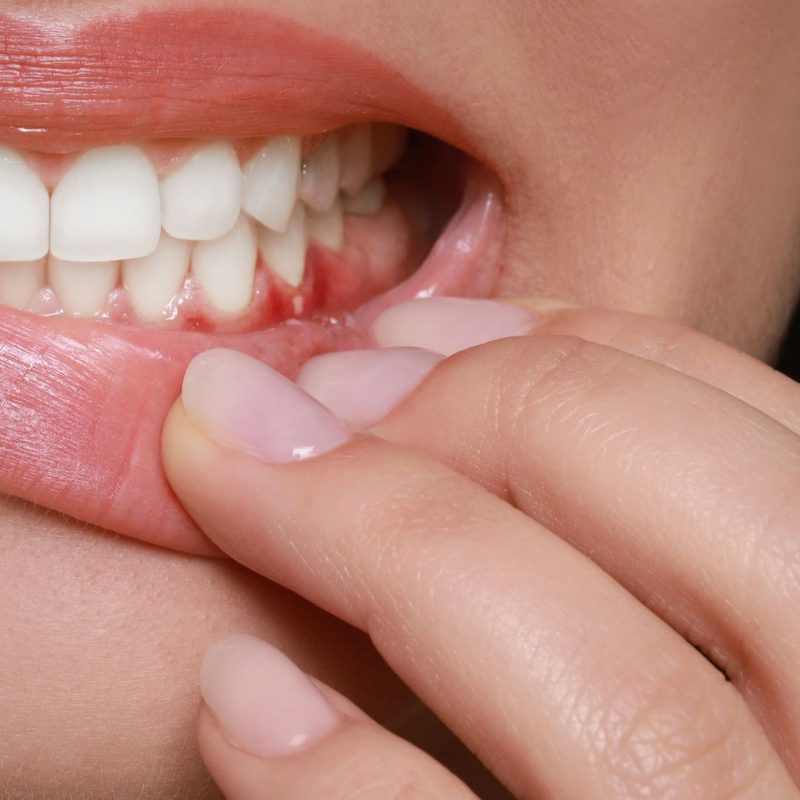 Dental abscess causes treatments