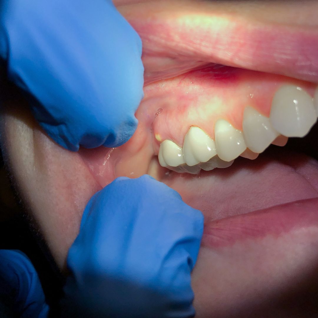 Dental abscess causes treatments