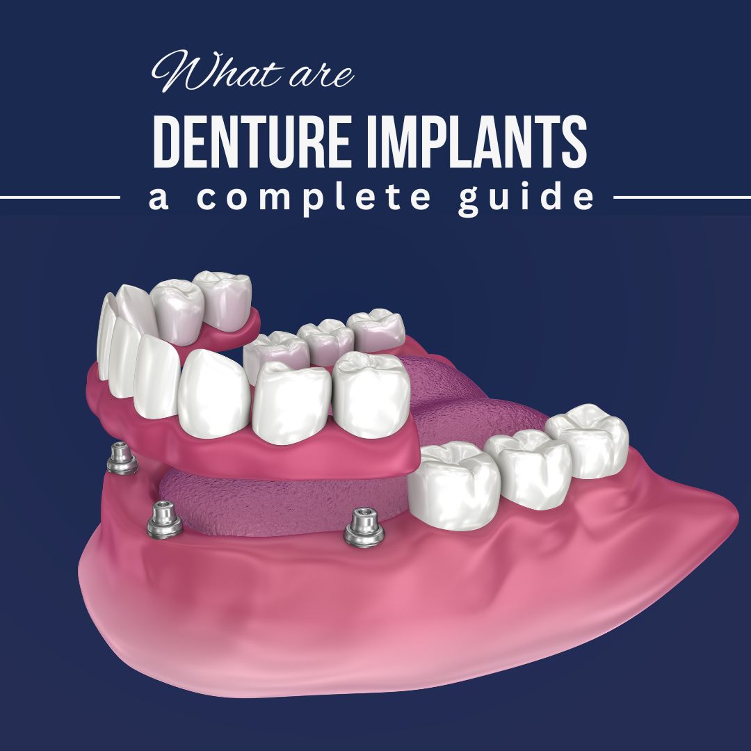 Denture Implants in Istanbul Turkey Guide