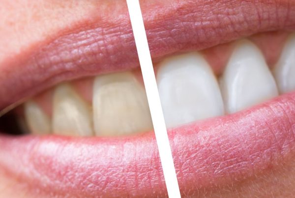 diş beyazlatma ümraniye dudullu