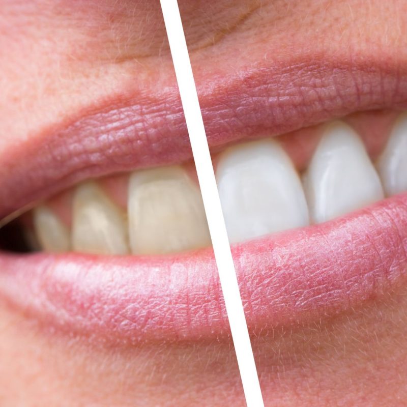 diş beyazlatma ümraniye dudullu