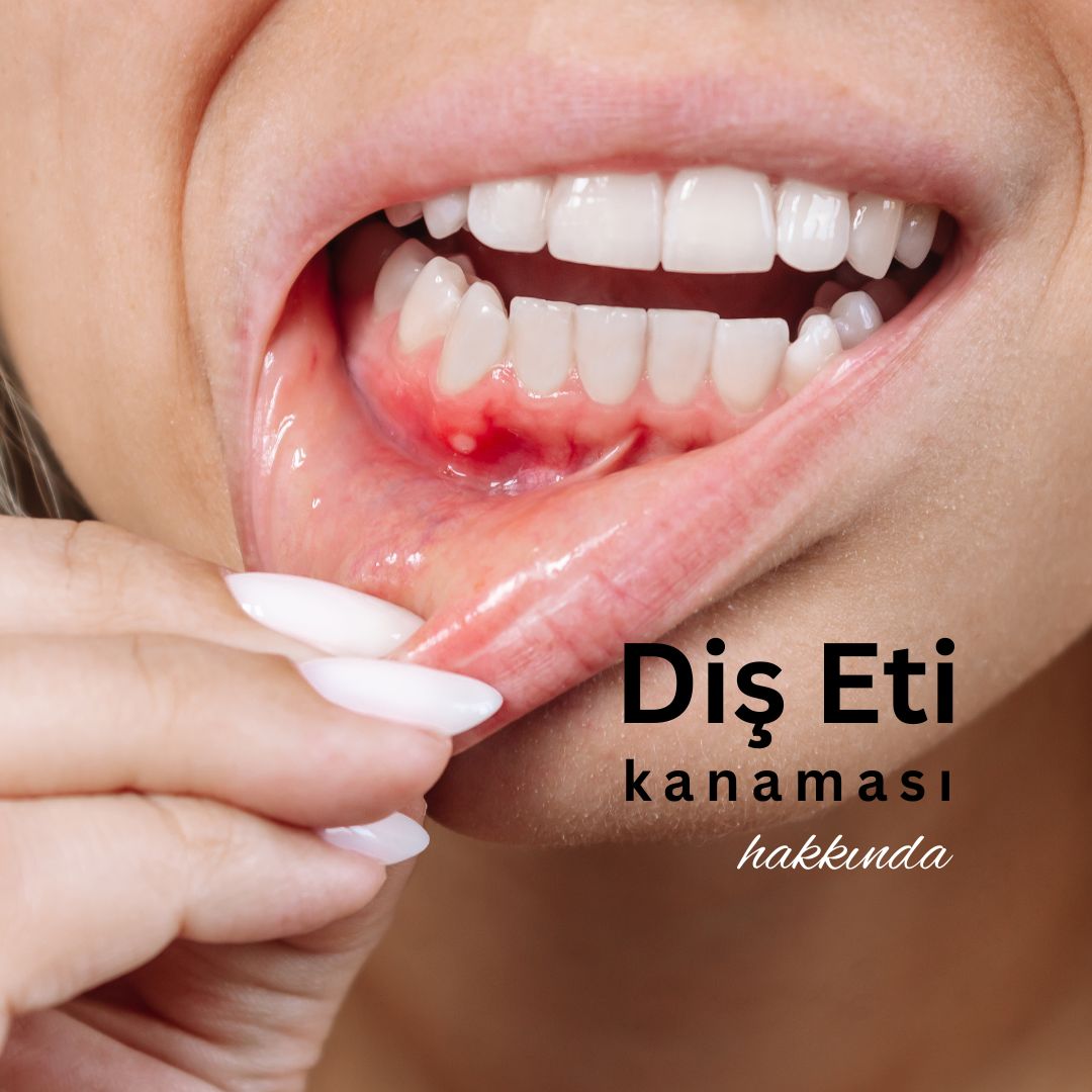 diş eti kanaması hakkında