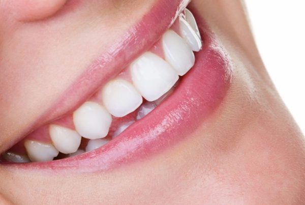 diş porselen lamine kaplaması