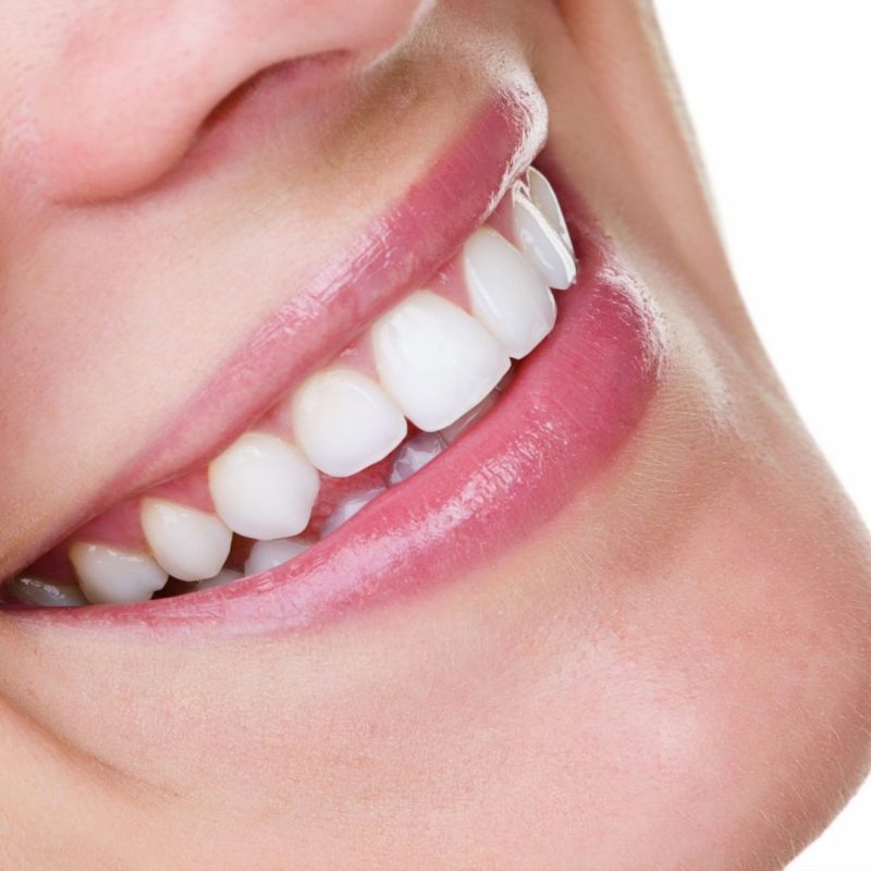 diş porselen lamine kaplaması