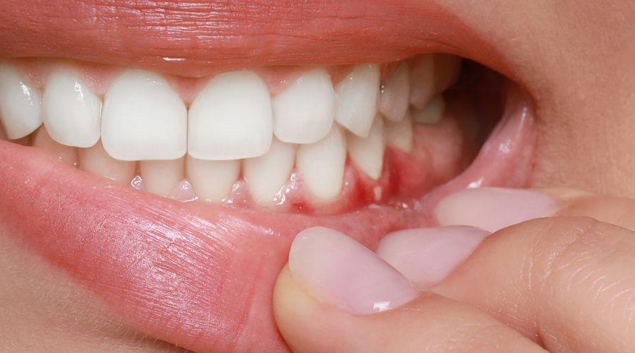 how gum infection looks like