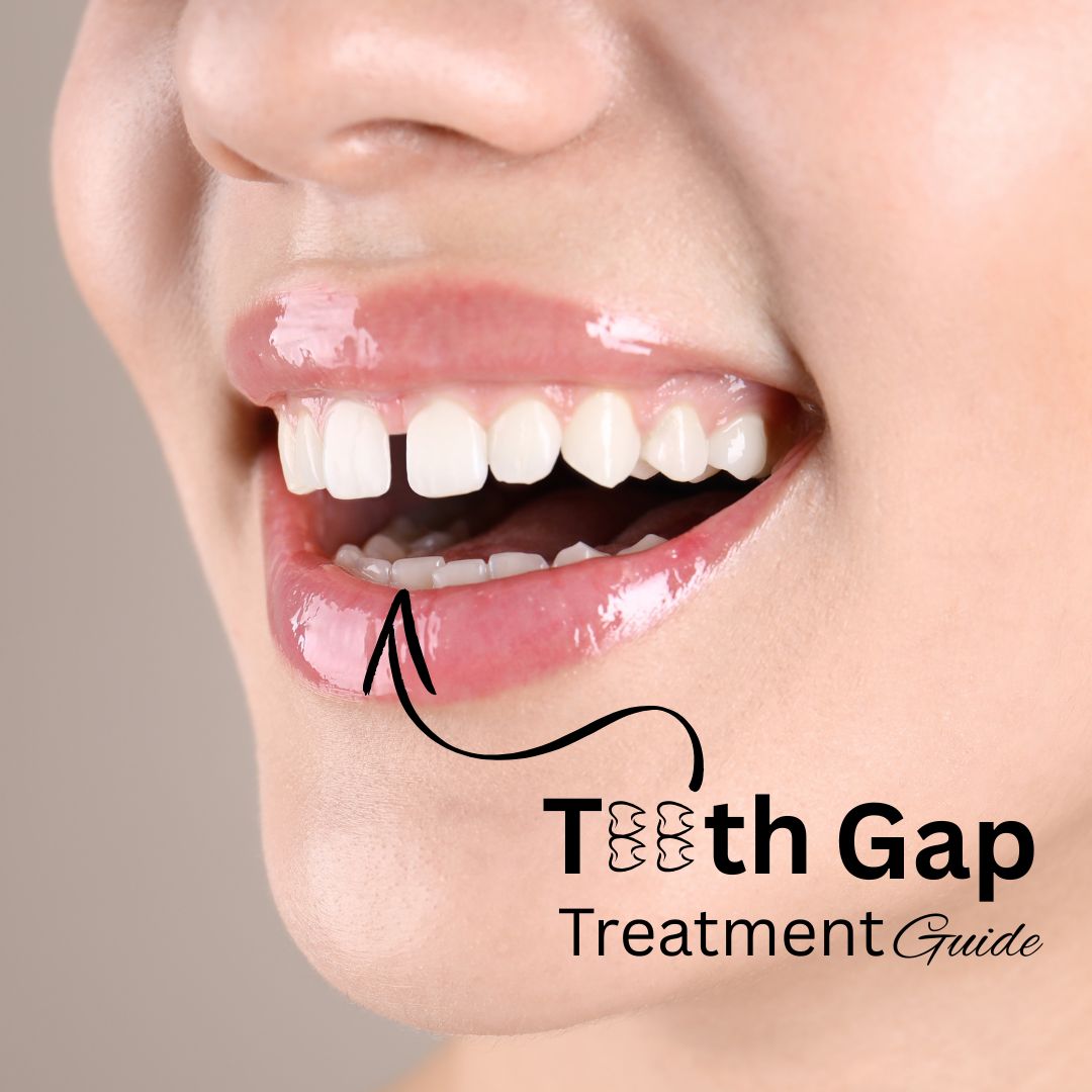 Teeth gap treatment