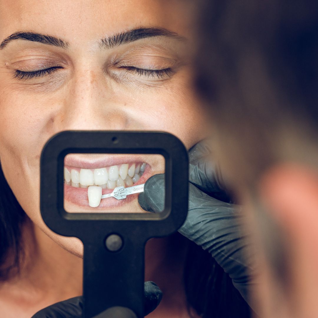 Top 10 Dental Veneers Brands – Price Comparison 2025