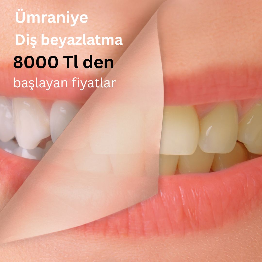 diş beyazlatma fiyatları ümraniye