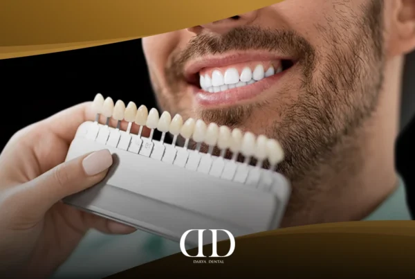 E-max veneers