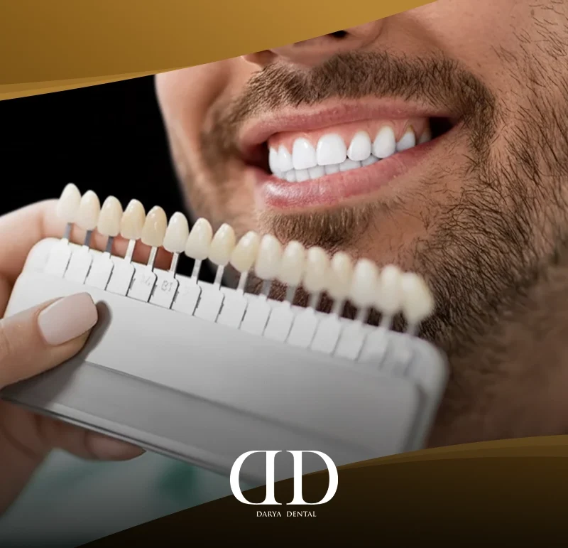E-max veneers