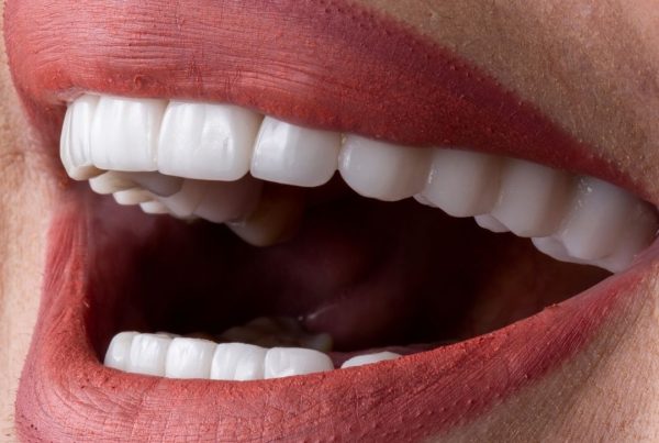 As a dentist with over 20 years of experience at Darya Dental Clinic in Istanbul, Turkey, I’m thrilled to help patients worldwide achieve stunning smiles through composite bonding ($150–$200 per tooth) and laminate veneers ($250–$350 per tooth, including E-max porcelain). Istanbul is a leading hub for dental tourism, offering top-tier cosmetic dentistry at 60–80% less than in countries like the UK or USA. At Darya Dental Clinic, we welcome international patients seeking affordable, high-quality treatments while enjoying the vibrant culture of Istanbul. In this 2025 guide, I’ll outline the costs, procedures, benefits, and essential tips for getting composite bonding or laminate veneers at our clinic, empowering you to plan your dental journey with confidence.