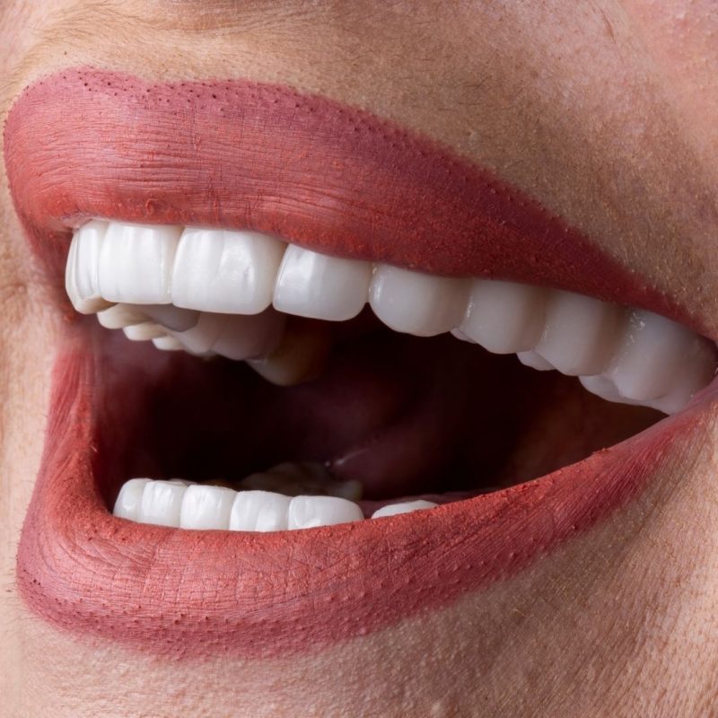 As a dentist with over 20 years of experience at Darya Dental Clinic in Istanbul, Turkey, I’m thrilled to help patients worldwide achieve stunning smiles through composite bonding ($150–$200 per tooth) and laminate veneers ($250–$350 per tooth, including E-max porcelain). Istanbul is a leading hub for dental tourism, offering top-tier cosmetic dentistry at 60–80% less than in countries like the UK or USA. At Darya Dental Clinic, we welcome international patients seeking affordable, high-quality treatments while enjoying the vibrant culture of Istanbul. In this 2025 guide, I’ll outline the costs, procedures, benefits, and essential tips for getting composite bonding or laminate veneers at our clinic, empowering you to plan your dental journey with confidence.