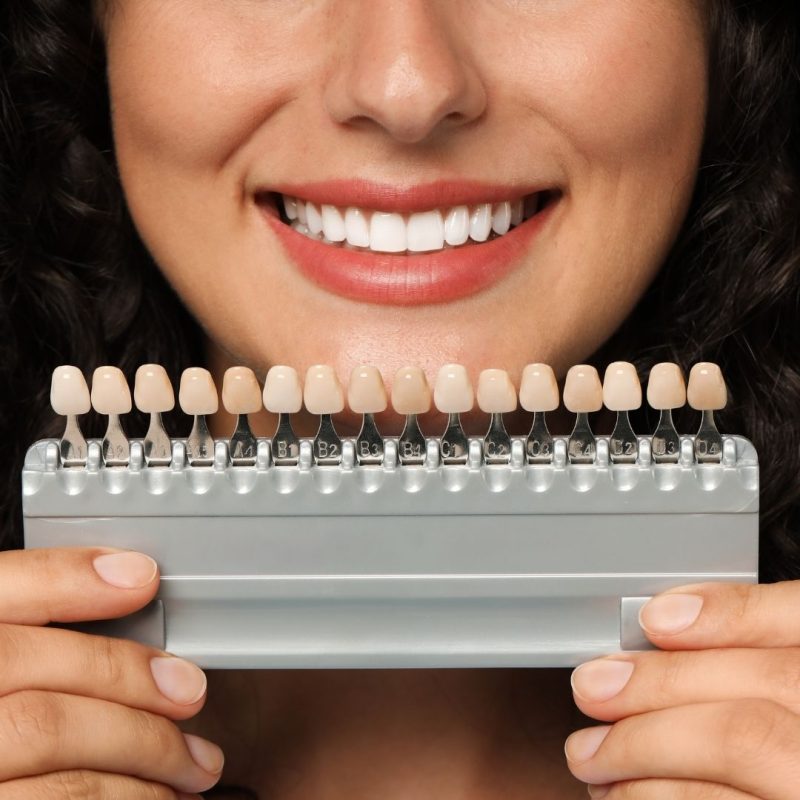 Composite Bonding and Laminate Veneers Cost in Istanbul